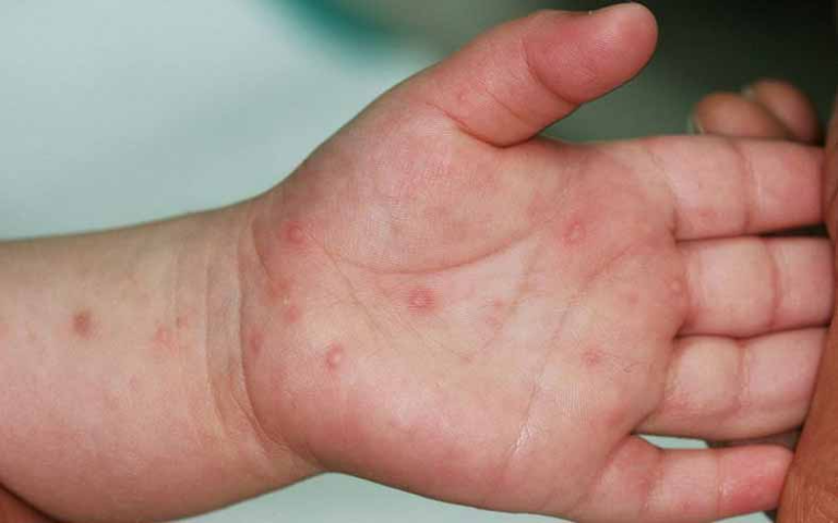 Tay chân miệng ở trẻ em: Triệu chứng và điều trị
