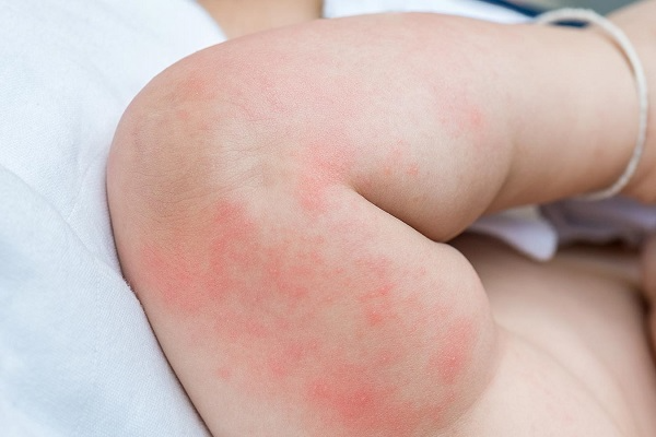 Nguyên nhân khiến trẻ bị rôm sảy