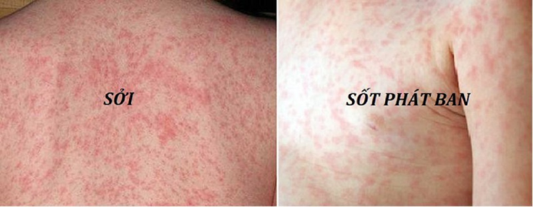 Trẻ nổi ban đỏ: Cách phân biệt ban sởi, ban virus