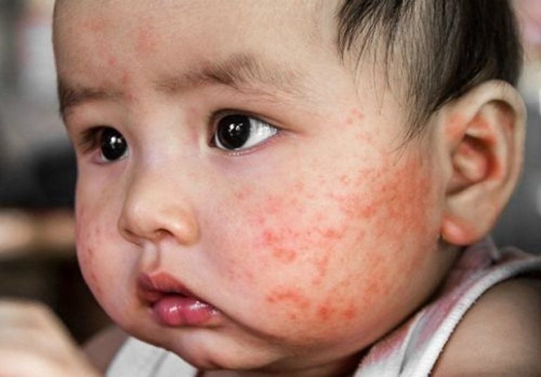 Chàm sữa ở trẻ nhỏ: Có lây không? Cách bôi thuốc an toàn