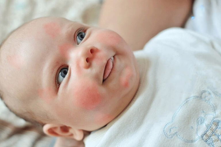 Trẻ bị dị ứng thời tiết: Cách xử lý và phòng ngừa