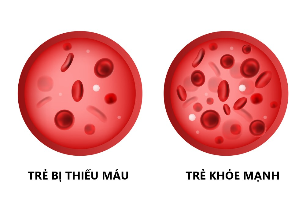 tre-bi-thieu-mau-feauture-image.png