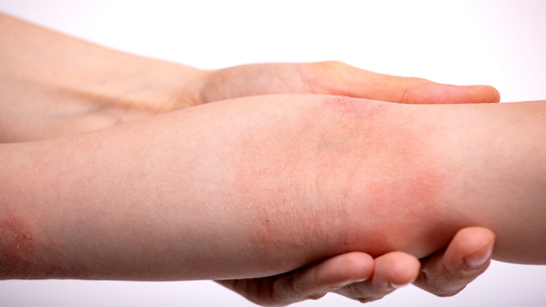 Viêm da cơ địa ở trẻ em: Kiêng gì và bôi gì?