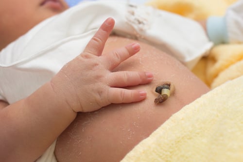 Mách mẹ cách vệ sinh rốn cho trẻ sơ sinh sạch sẽ tránh nhiễm trùng