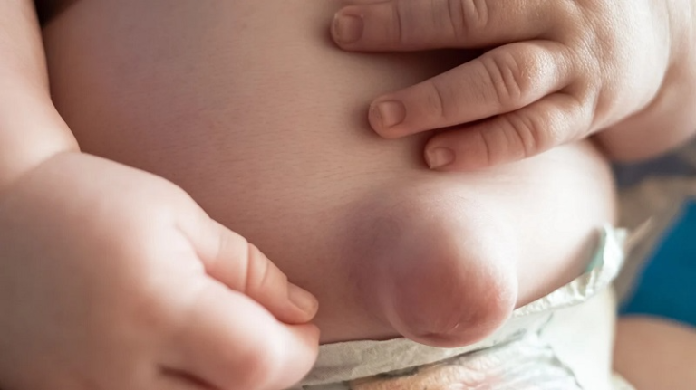 Thoát vị rốn có tự khỏi được không? Điều trị như thế nào?
