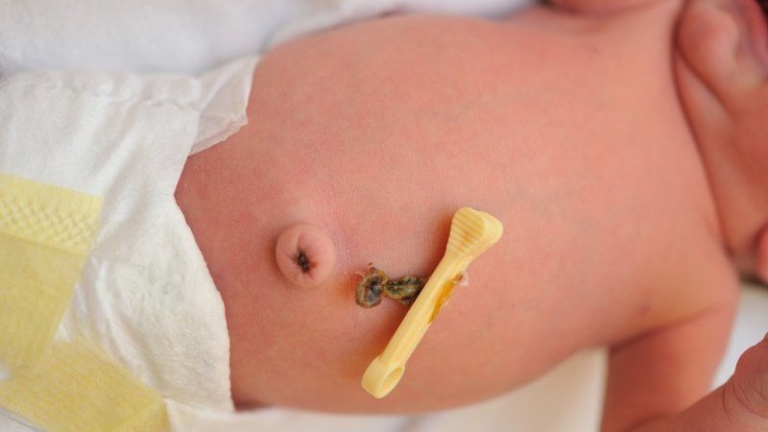 Thoát vị rốn bao lâu thì khỏi? Làm gì để nhanh khỏi?